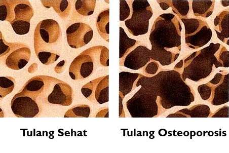 Gambar Tulang Osteoporosis