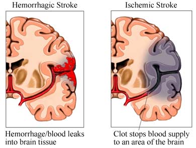 Gambar Penyebab Stroke