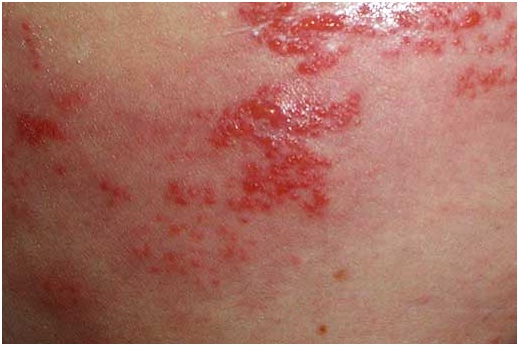 Penyakit Cacar atau Herpes